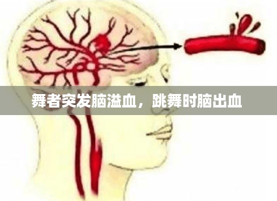 舞者突发脑溢血,跳舞时脑出血